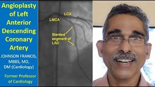 Angioplasty of Left Anterior Descending Coronary Artery