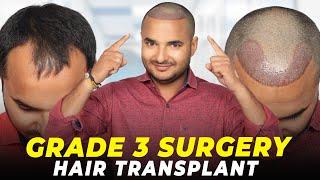 Hair Transplant in Alwar | Best Results & Cost of Hair Transplant in Alwar