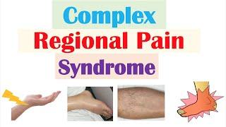 Complex Regional Pain Syndrome | Causes, Pathophysiology, Signs & Symptoms, Diagnosis, Treatment