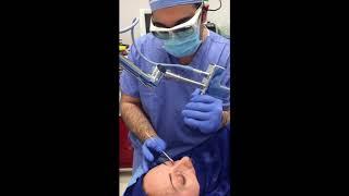 Laser Resurfacing with Blepharoplasty