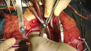 Complete Atrioventricular canal defect repair