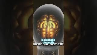 What Is Alcoholic Dementia? #facts #wellness #dementiaawareness  #AlcoholAwareness #BrainHealth