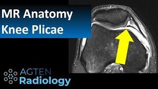 MRI Anatomy of Knee Plicae