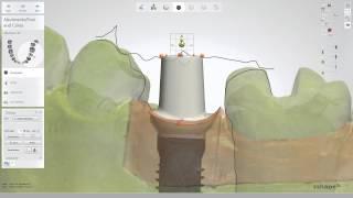 Customized abutment and a crown design