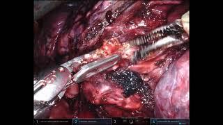 Cerfolio Surgery: MAI RLL Posterior