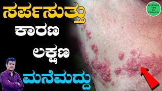 ಸರ್ಪಸುತ್ತು ಸಮಸ್ಯೆಗೆಮನೆ ಮದ್ದು | Sarpa Suttu in Kannada | Sarpa Suttu Symptoms in Kannada