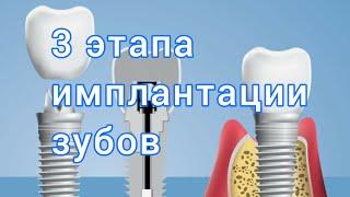 Что входит в ИМПЛАНТАЦИЮ зуба? ЭТАПЫ имплантации зубов.