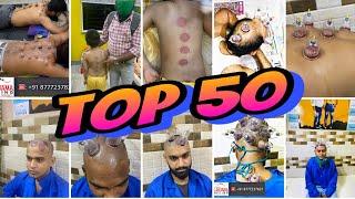 Al-Hijama Cupping Treatment Therapy | TOP 50 |