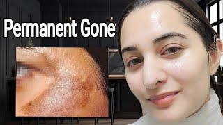 Permanent solution of Skin Dark Spot Scars and  Patches Magical World Best Remedy