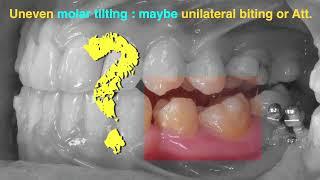 Treatment of Class III Malocclusion with Clear Aligner｜【Chris Chang Ortho】CC711