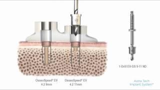 Astra Tech Implant System™ EV Guided surgery – drilling with tube | Dentsply Sirona