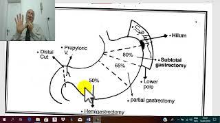 Gastric surgery 7 ( chronic peptic ulcer 6 , treatment part 1  ) , by Dr. Wahdan .