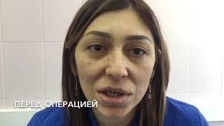 Удаляли биополимер из губ три раза