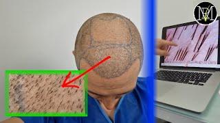 Day 1/2 of my 2nd Hair Transplant - Finished!