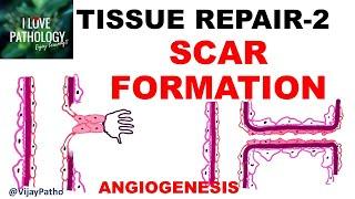 TISSUR REPAIR Part 2: Repair by SCAR formation.  ANGIOGENESIS, GRANULATION TISSUE, TISSUE REMODELING