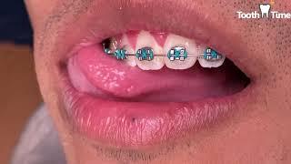 Braces checkups - Last Visit before getting braces off - Tooth Time Family Dentistry New Braunfels