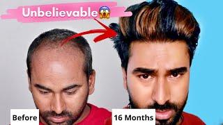 One of the Best Hair Transplant Result Ever |Hair Colour After Hair Transplant|Month by Month Result