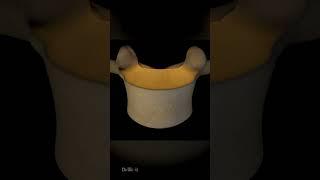 Osteoporosis of the Vertebra