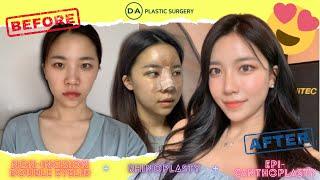 My double eyelid, epi-canthoplasty, and rhinoplasty surgery before and after in Korea!