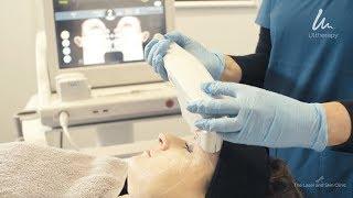 ULTHERAPY - the amazing non-surgical skin lifting treatment