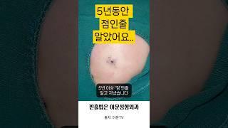 5년이상 점인줄 알았어요  (핀홀법 수술 피지낭종 표피낭종 피부과 성형외과 병원 흉터 epidermal cyst surgery hospital seoul korea)[아문TV]