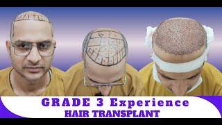 Hair Transplant in indore | Best Results & Cost of Hair Transplant in indore