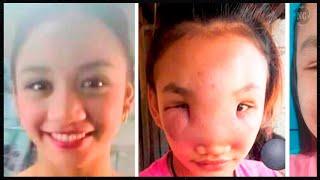 Remember the WOMAN who became DEFORMED after POOKING her FACE? She RECOVERED, but DOCTORS WARN