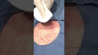 Meet some OG Popaholics  This patient came in with his son to get two cysts removed