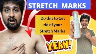 100% Working Remedy | Reduce STRETCH MARKS | Dr Niranjan Samani