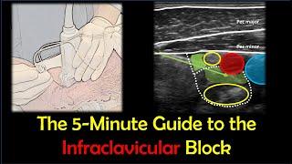 Infraclavicular Brachial Plexus Block - a "How-To" Guide