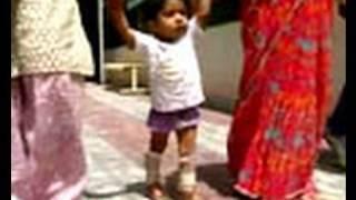 Jaipur Foot gives new lease of life to 2-year-old