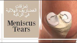 Meniscus Tears