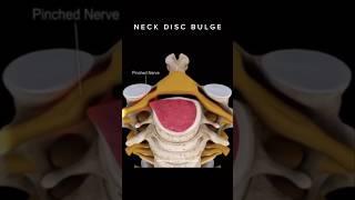 Neck Disc Bulge. #discbulge #neckpain