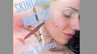 My Acne Travel Skincare Routine! (Natural Acne Treatment) August 2015 | Cassandra Bankson