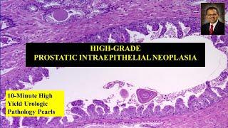 High-grade prostatic intraepithelial neoplasia (HGPIN)