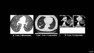 tkr_htp 13 CAVITATORY LUNG NODULES WITH 'CAVITY' MNEMONIC