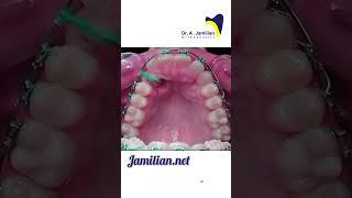 Canine Impaction #dentist#bracing #orthodontics#canine_impaction#Impaction#Exposure#Canine_exposure