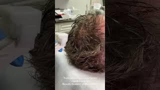 Hair Restoration BB&PRP   FR