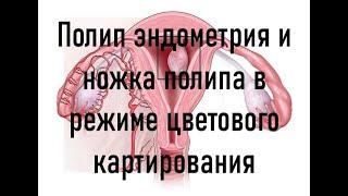 Полип эндометрия и ножка полипа в режиме цветового картирования