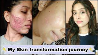 My skin transformation journey / Cystic acne , red scar #shorts