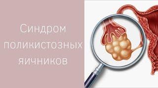 СИНДРОМ ПОЛИКИСТОЗНЫХ ЯИЧНИКОВ | Как лечить? Как забеременеть?