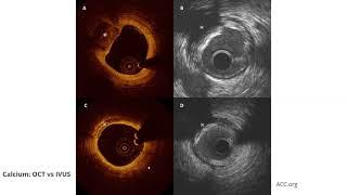 OCT (Optical Coherence Tomography)- Elias Hanna, Univ of Iowa