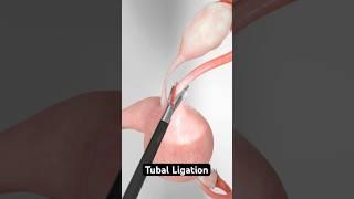 Three methods for permanent female sterilization (3D Animation)
