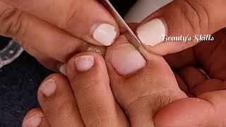 Easy way cutting the side of  toenail|ingrown removal(Part1) | Beauty's Skills