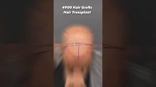 Hair Transplant with 4900 Hair Grafts at Cara Clinic Mumbai