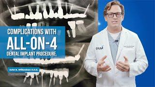 Complications with all-on-4 dental implant procedure.