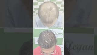 Hair Transplant | Dr. Ashutosh Shah | Elegance Clinic - Surat #eleganceclinic  #hairtransplant