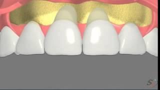 soft tissue grafting scenario 1