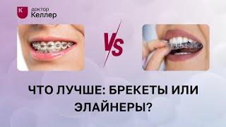 Что лучше: брекеты или элайнеры?