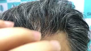 Genuine Hairline by Dr. Jangid | Best Hair Transplant Surgeon| | Delhi